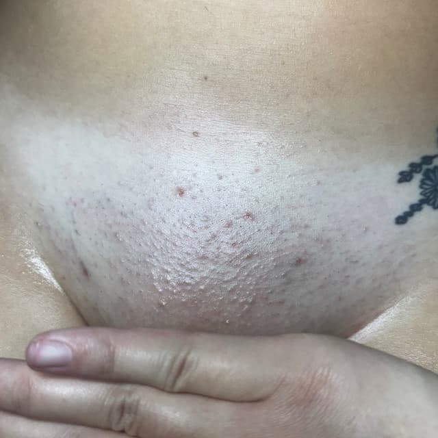 Brazilians for a Year! at Bare Society Aesthetics in Hialeah, FL
